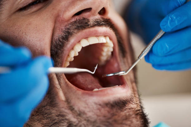 Best Emergency Dentist for Lost Fillings or Crowns in Carrollton, VA